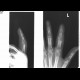 Osteomyelitis of finger: X-ray - Plain radiograph